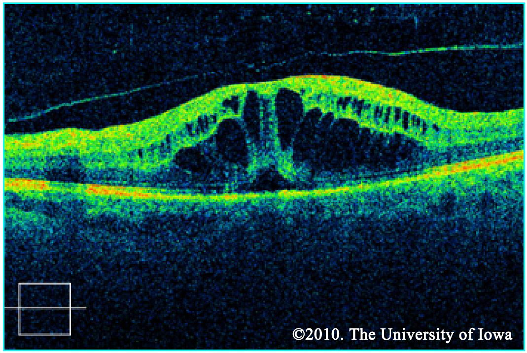 Diabetic Retinopathy for Medical Students. EyeRounds.org
