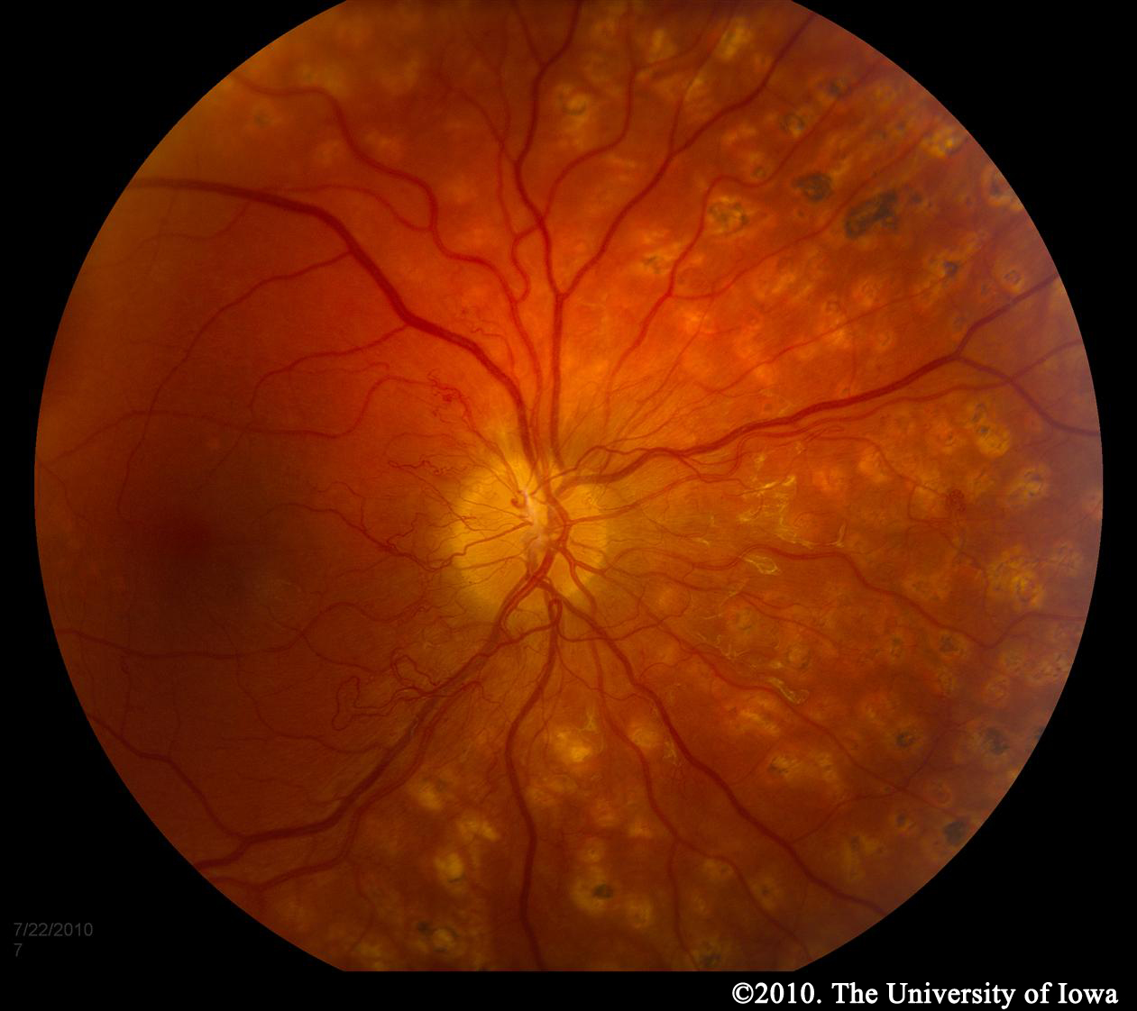 Diabetic Retinopathy for Medical Students.