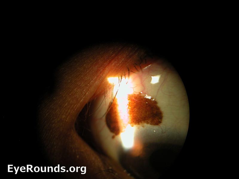 Slit lamp photograph displaying conjunctival nevus