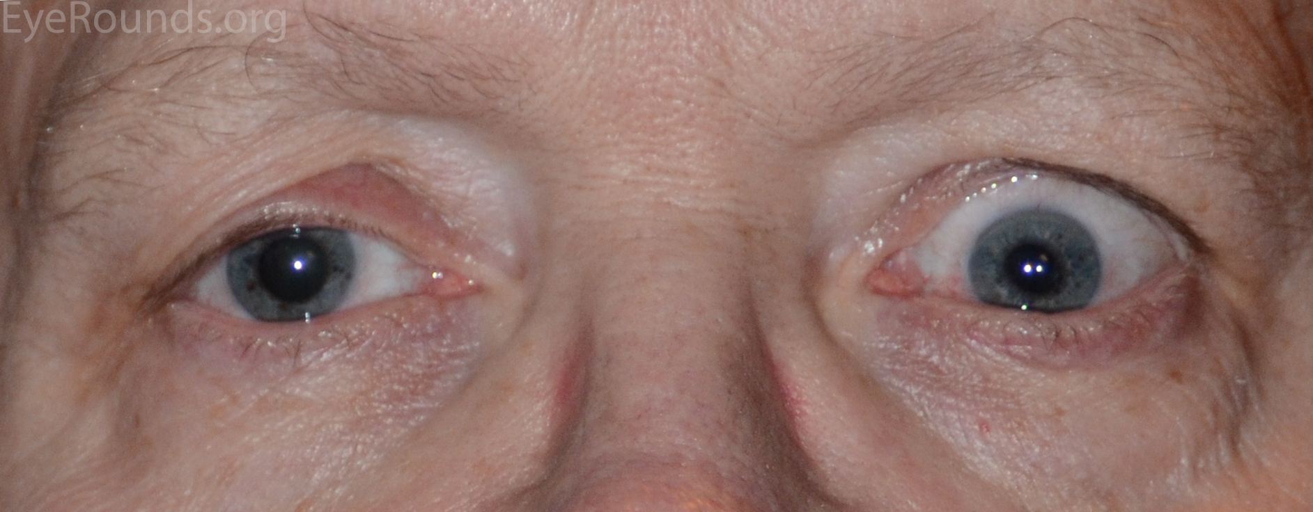 pseudoptosis in right eye due to lid retraction in the contralateral eye 
