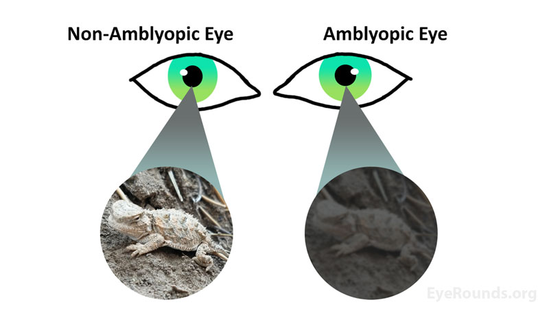Representation of visual suppression in amblyopic and non-amblyopic eyes.
