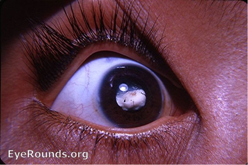 Example of a pediatric cataract that can lead to deprivation amblyopia