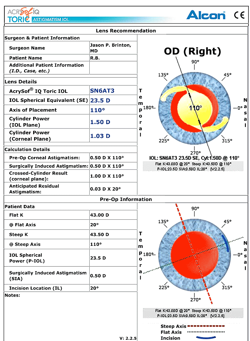 Toric IOL calculator results 