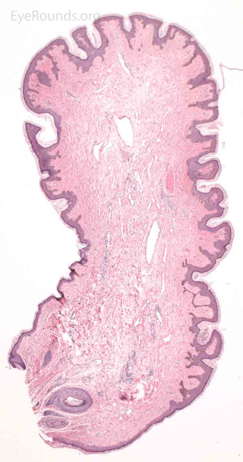 Acrochordon pathology