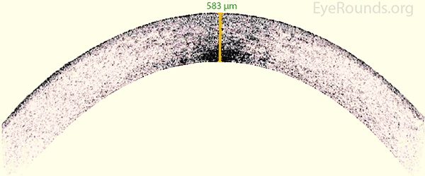 OCT imaging is used to determine the thickness of the corneal tissue