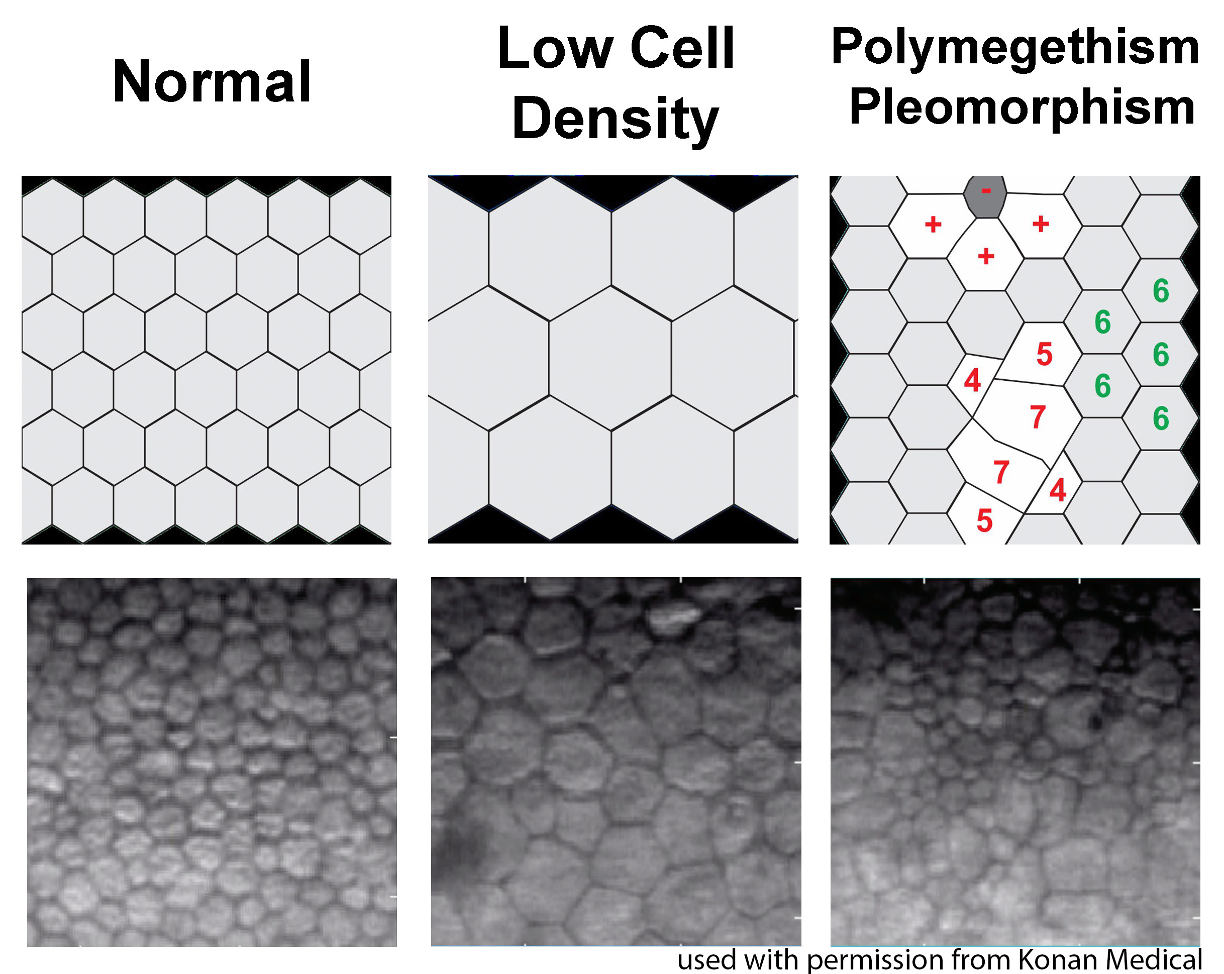 OCT imaging is used to determine the thickness of the corneal tissue