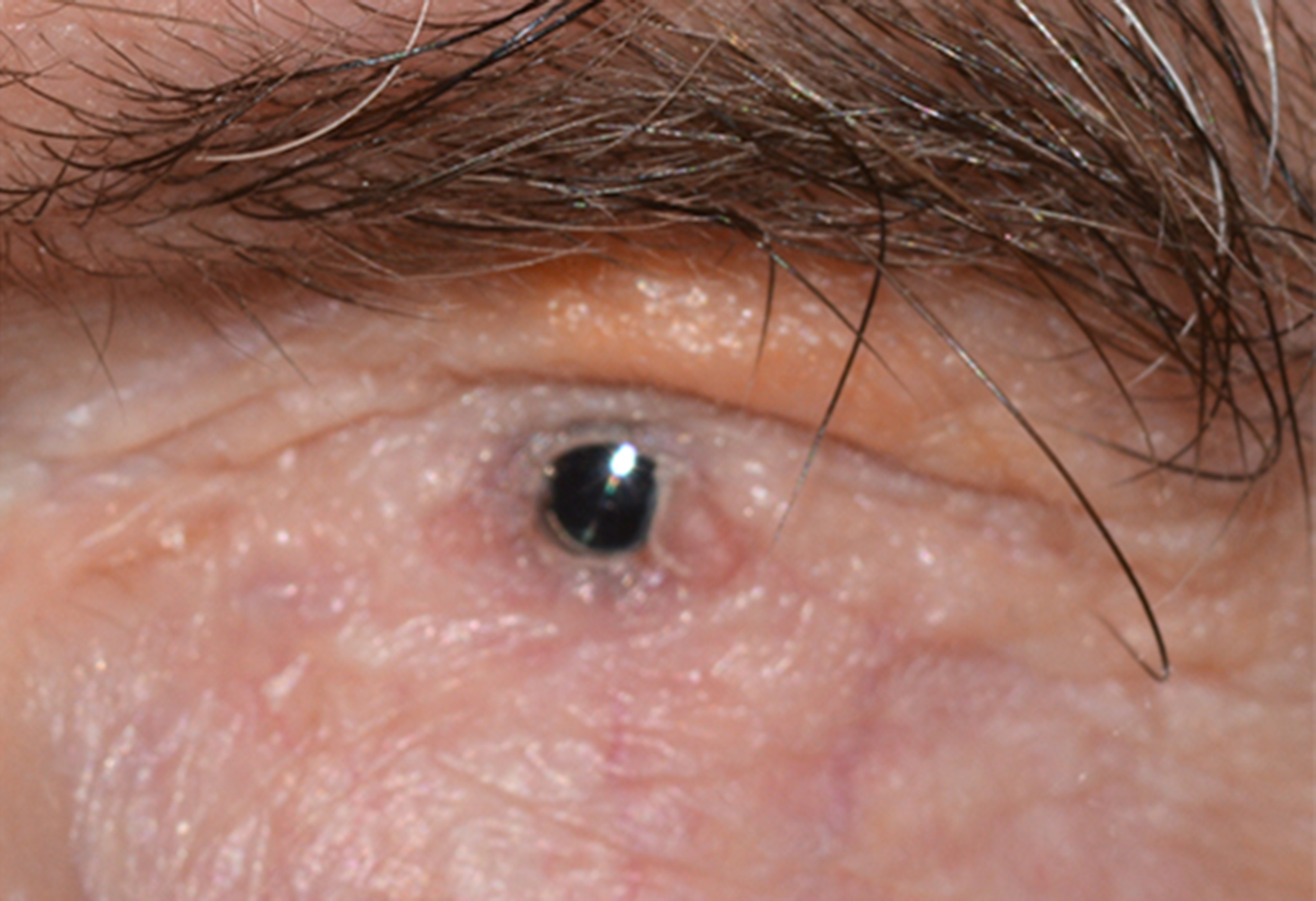 Boston Type II KPro for severe ocular cicatricial pemphigoid