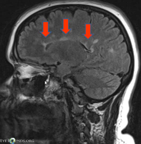 FLAIR MRIs showing lesions typical of MS