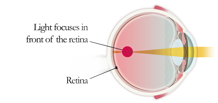 depiction of myopia 
