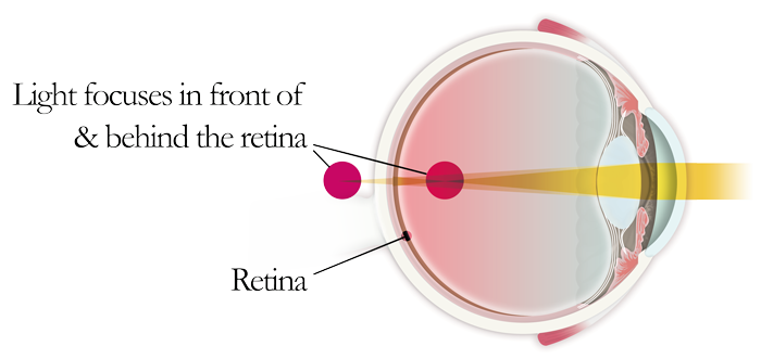 depiction of astigmatic eye 