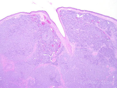 Merkel Cell Carcinoma Histology