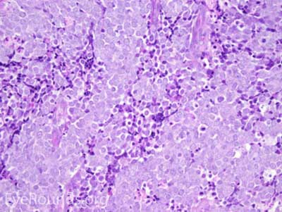Merkel Cell Carcinoma Histology