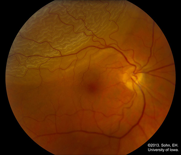 Bullous superotemporal rhegmatogenous retinaavlossning på höger öga