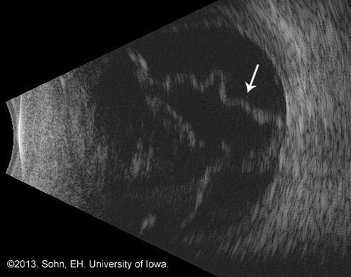 B-Scan eines Auges mit Netzhautablösung. Die helle, reflektierende Schicht am hinteren Pol (durch den Pfeil gekennzeichnet) entspricht der Netzhaut, die sich von der Augenwand gelöst hat