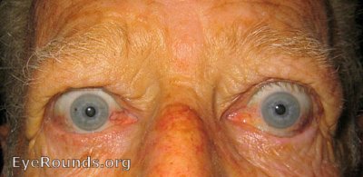 periorbital edema, eyelid retraction, scleral show, and conjunctival injection