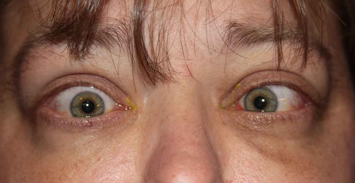 Esotropia. Note the horizontal misalignment of the eyes in primary gaze. This is due to an enlarged and restricted medial rectus muscle.
