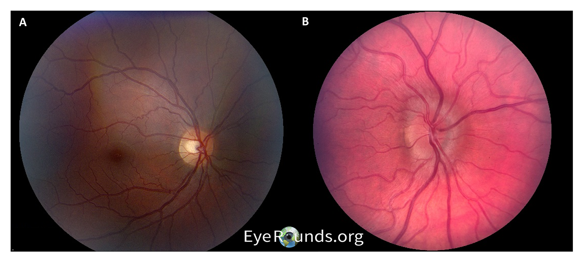 normal optic disk vs optic disk with mild papilledema
