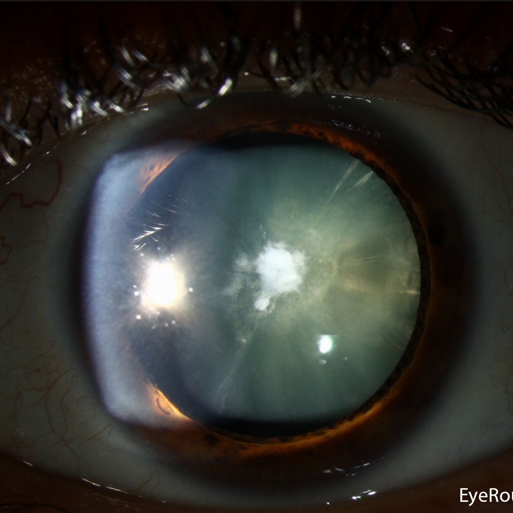 Lens and Cataract Header