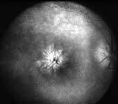 Chronic macular edema