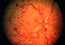 Ophthalmoscopically looks like non-ischemic CRVO