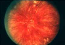 fundus hemorrhages and few cotton-wool spots