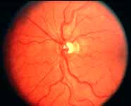 fundus example normal 