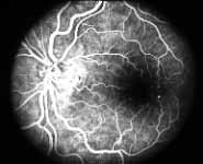  fluorescein fundus angiogram with no capillary obliteration and perfectly normal retinal vascular beds