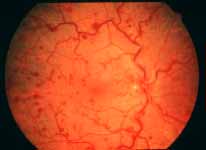 Fundus photograph of an eye with non-ischemic CRVO
