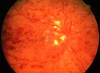 Fundus almost total non-perfusion of the retinal capillary bed, indicating that this is an ischemic CRVO