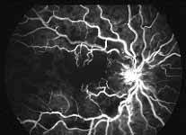 An angiogram almost total non-perfusion of the retinal capillary bed, indicating that this is an ischemic CRVO 