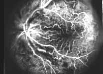 retinal capillary bed filled very well