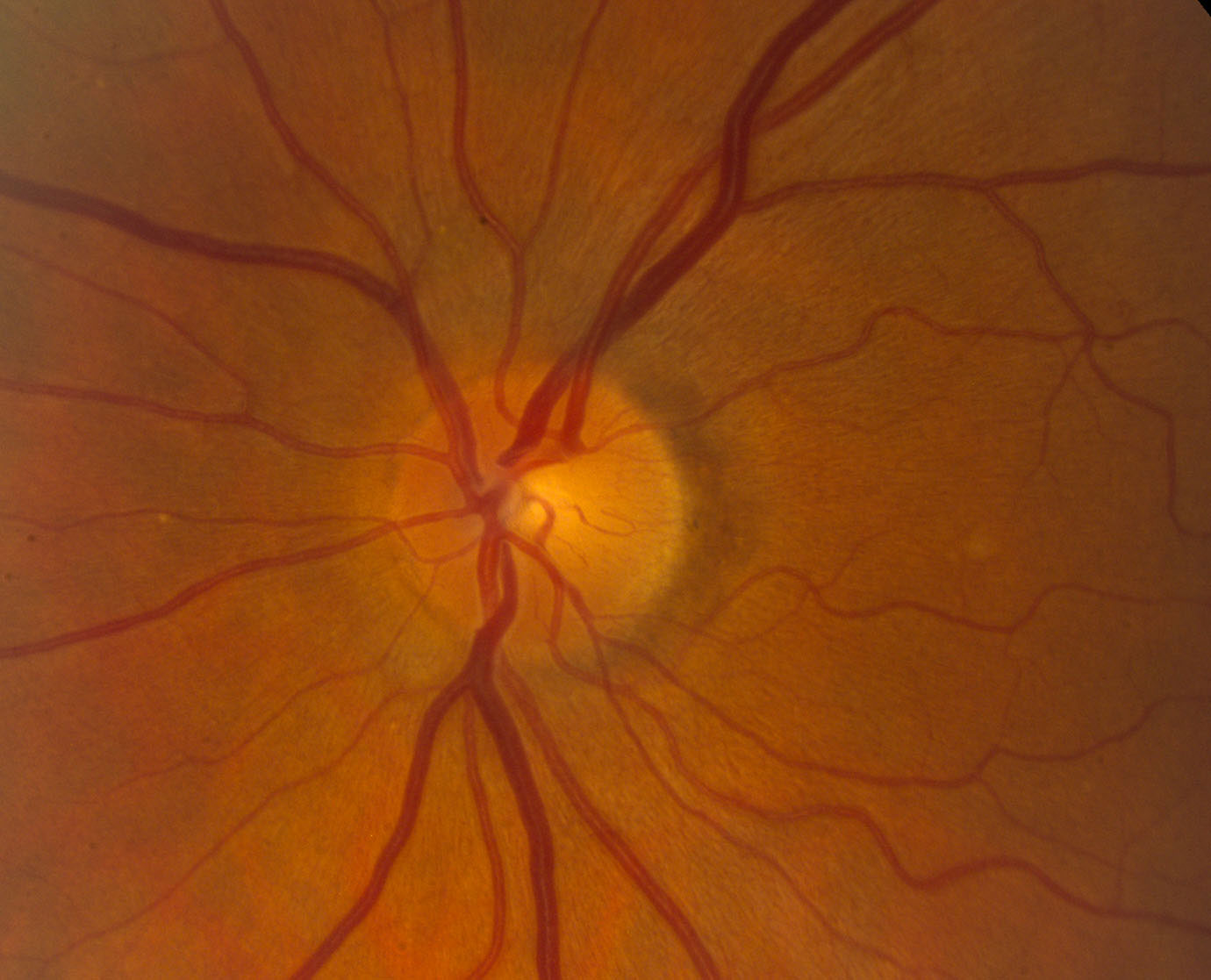 Аномалия развития зрительного нерва. Ишемическая нейропатия глазное дно. Патология зрительного нерва гистология.