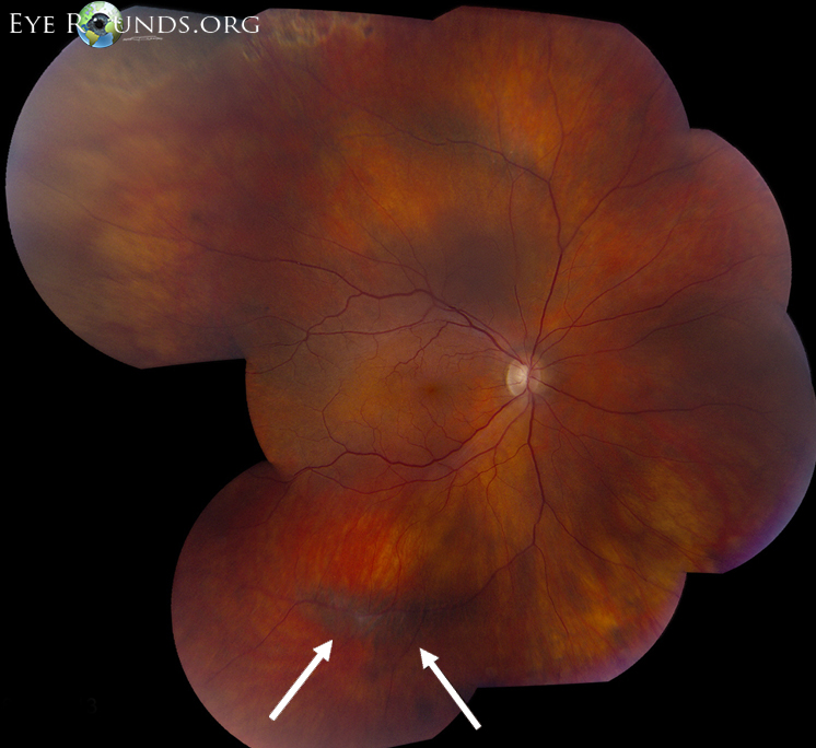 OD: radial perivascular lattice with sclerotic vessels and hyperplastic retinal pigment epithelium