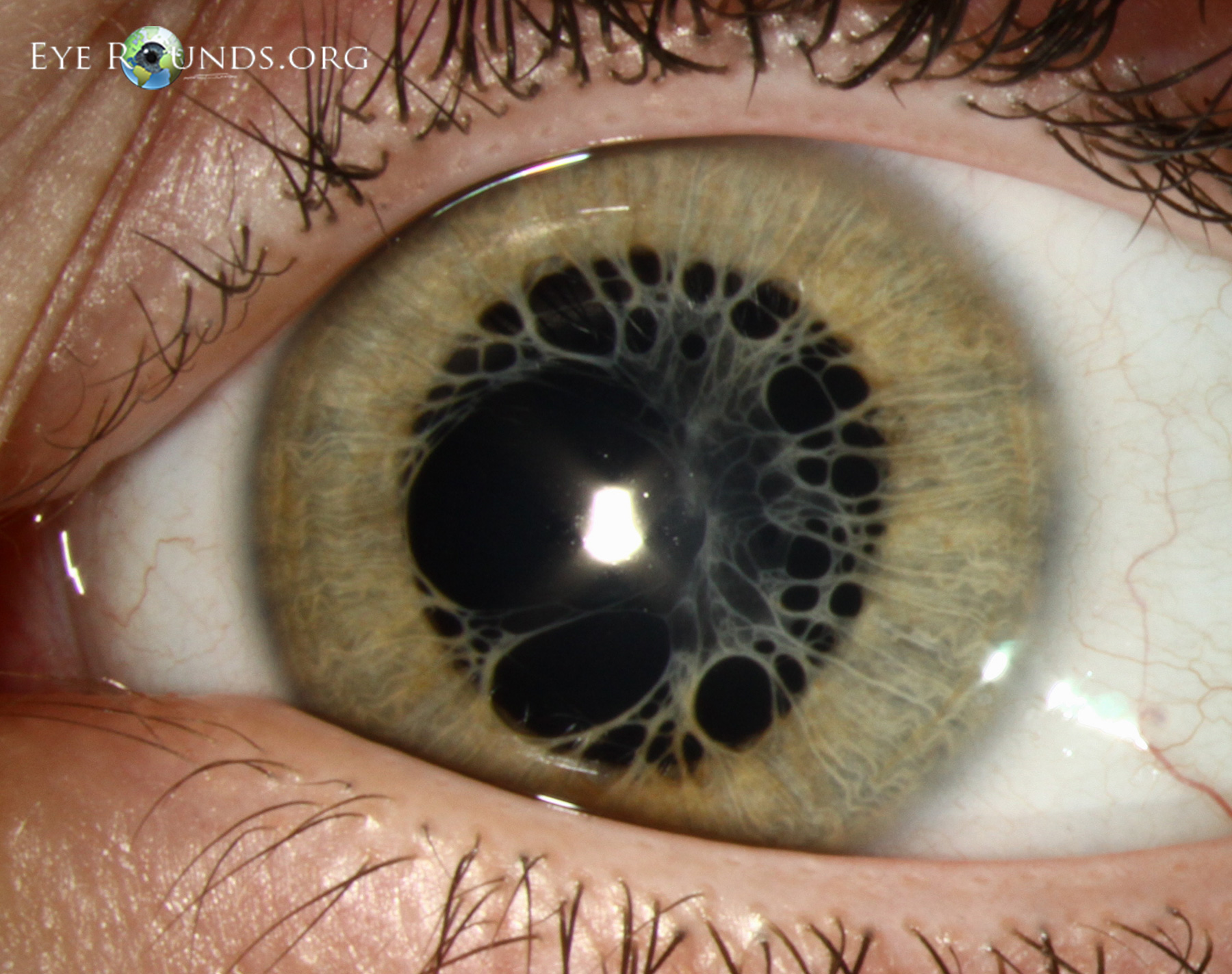 Persistent pupillary membranes other eye