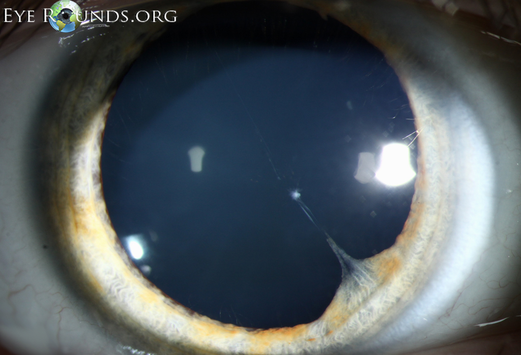 external photo showing Persistent pupillary membrane is an embryologic remnant of the tunica vasculosa lentis