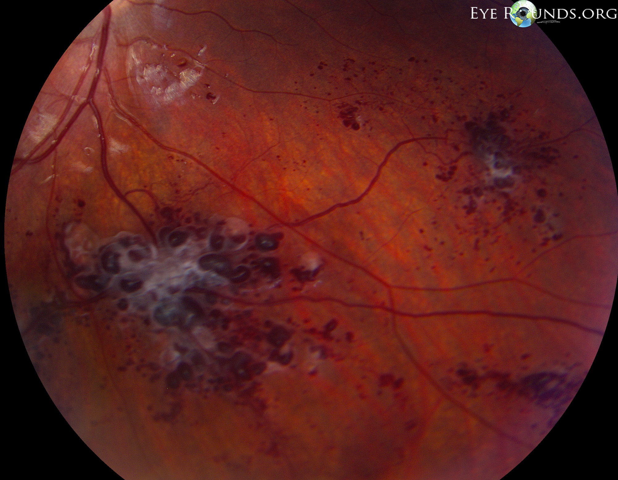 Retinal Cavernous Hemangiomas The University Of Iowa Ophthalmology
