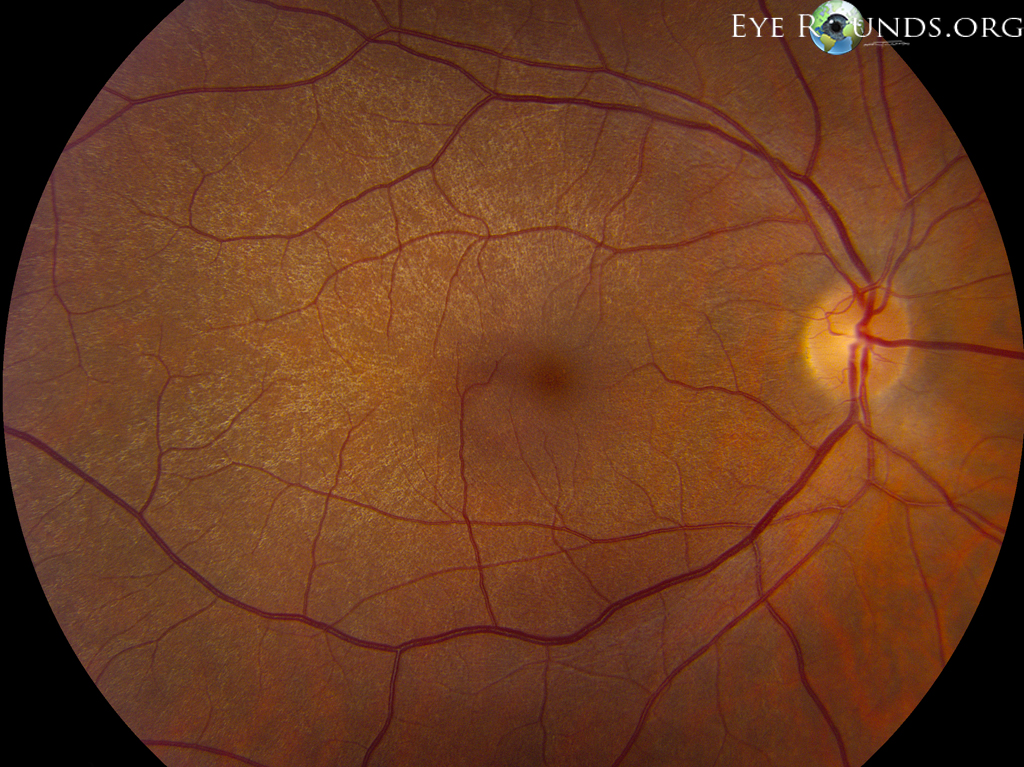 fundus showing tapetal sheen associated with the carrier state of X-linked retinitis pigmentosa OD