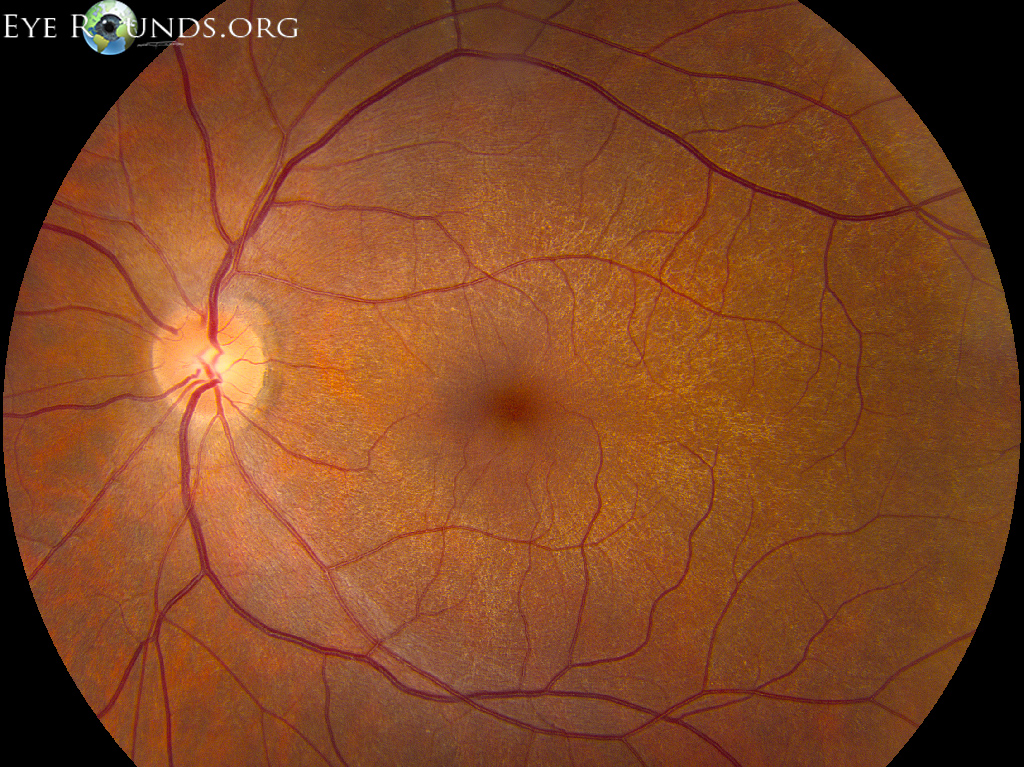 fundus showing Tapetal sheen associated with the carrier state of X-linked retinitis pigmentosa OS