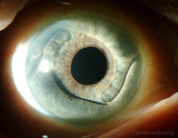 Anterior chamber intraocular lens (ACIOL) implant