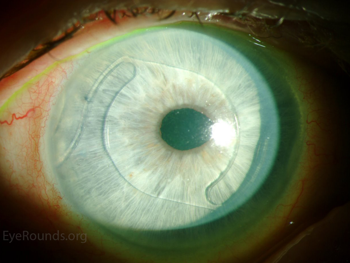 anterior chamber intraocular lens (ACIOL) implant