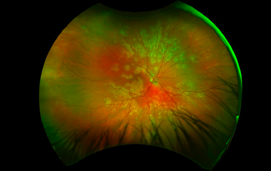Fundus photograph, right eye. Creamy placoid lesions in the posterior pole with peripheral subacute placoid lesions with pigmentary changes and atrophic appearance