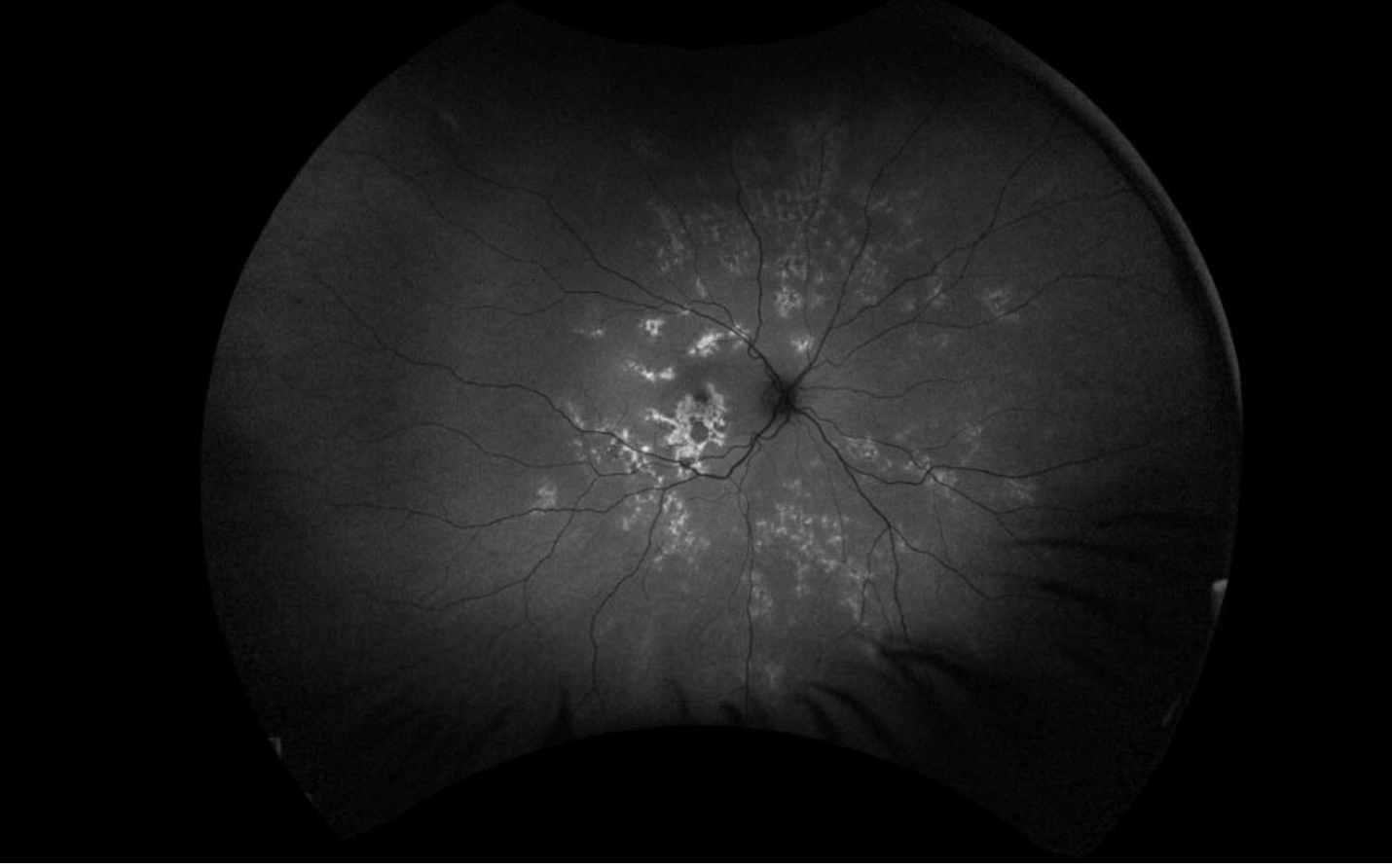 Fundus autofluorescence, right eye. There are multiple patches of hyperautofluorescence with granular hypoautofluorescence located in the macula and midperiphery