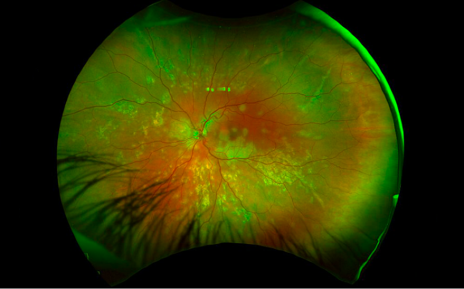 Fundus photograph, left eye. Creamy placoid lesions in the macula with subacute placoid lesions in the periphery with pigmentary and atrophic appearance.