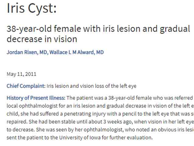 Case-Study: Iris Cyst