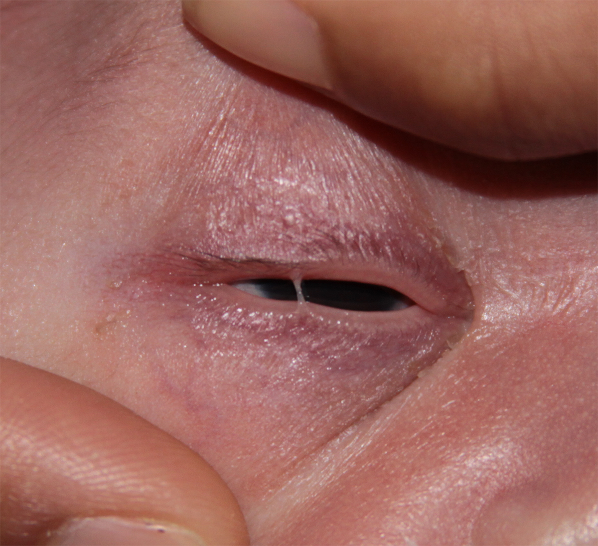 Fused part of the eyelid margins