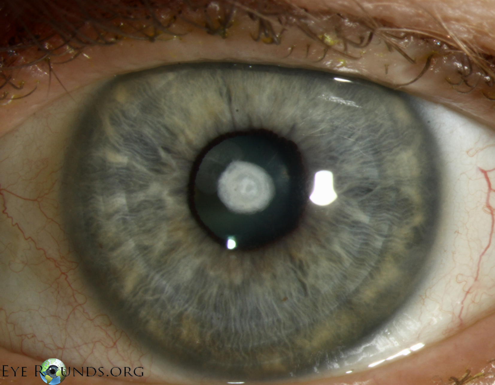 Затуманенное зрение. Врожденная Полярная катаракта. Заднеполярная катаракта. Васкуляризированное бельмо роговицы. Тринитротолуоловая катаракта.