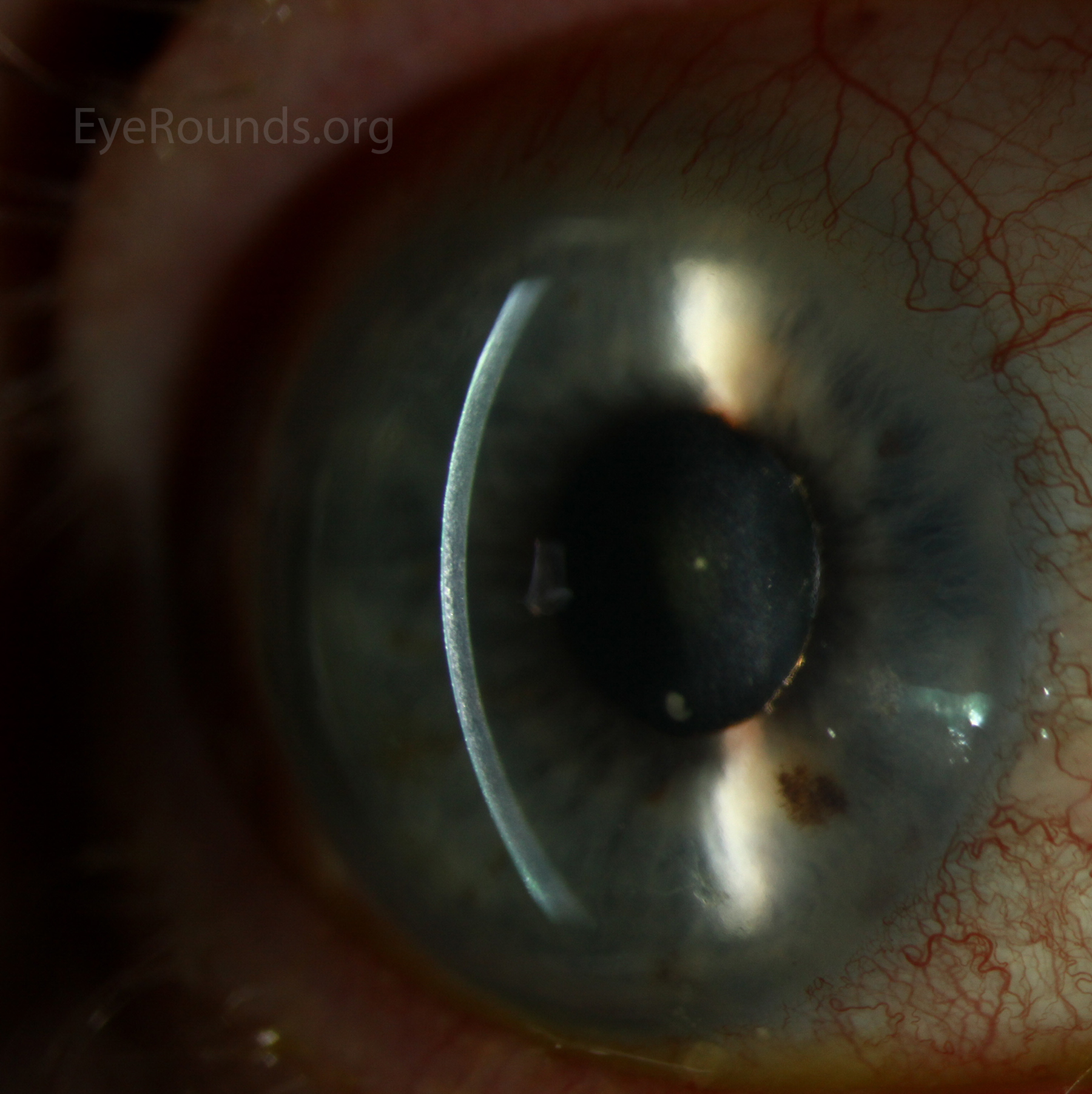 Corneal haze is most easily visible when using the slit beam seen using the slit beam
