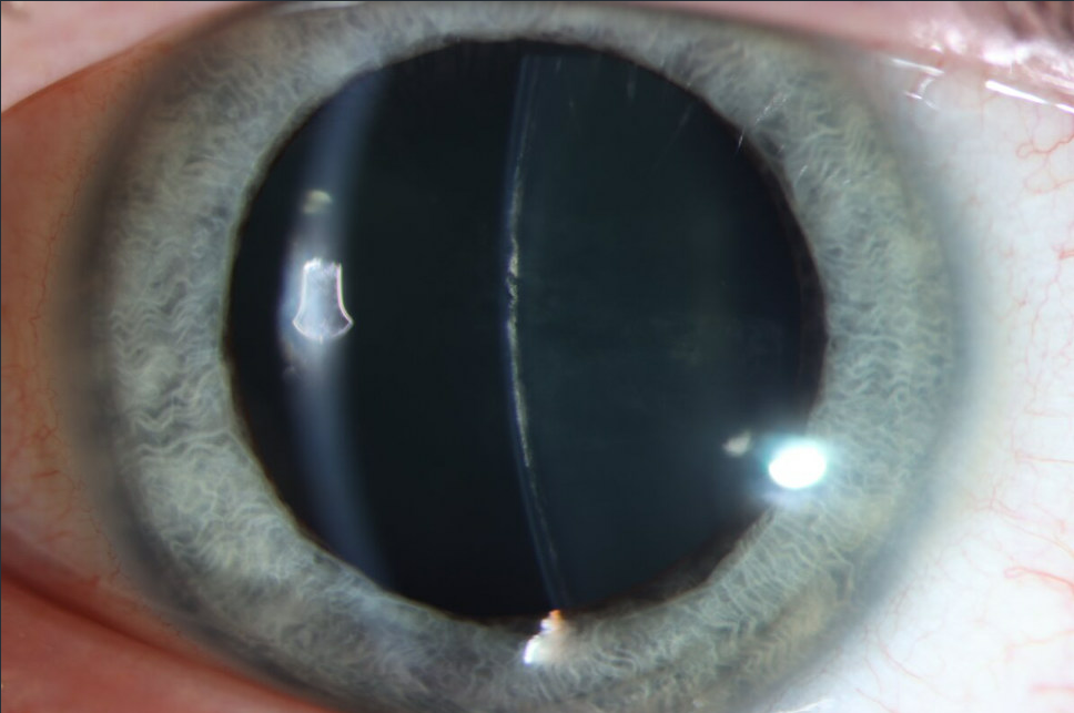 Anterior Subcapsular Catract