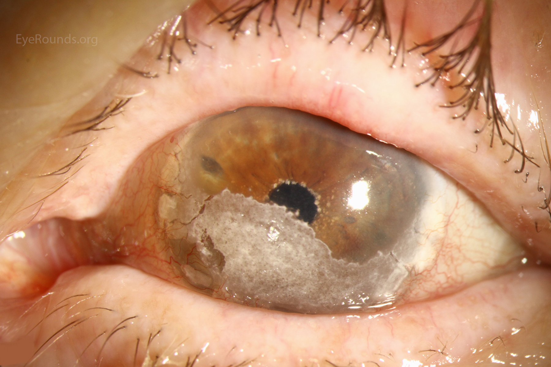 BK usually begins as fine, yellow-white deposits in the periphery that may coalesce over time to form a horizontal band across the cornea