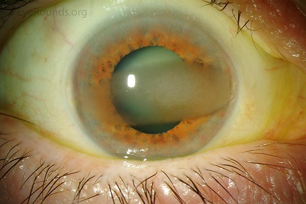 Related Case Band Keratopathy